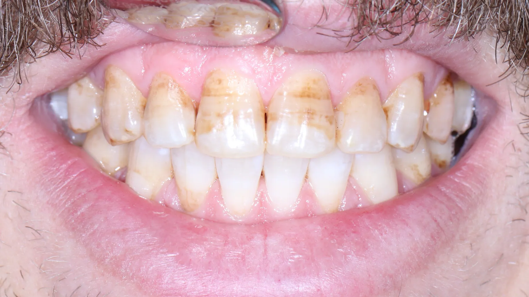 Tratamentul fluorozei (Icon) — Înainte